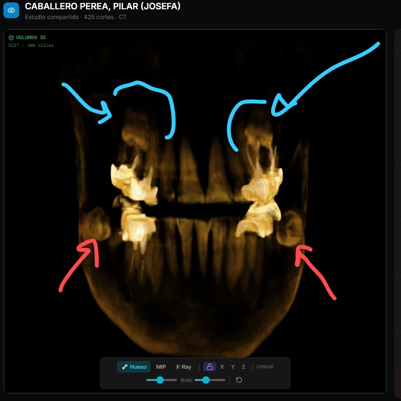 Renderizado 3D volumétrico frontal del cráneo en RADIA, modo Hueso con controles MIP, X-Ray y Umbral