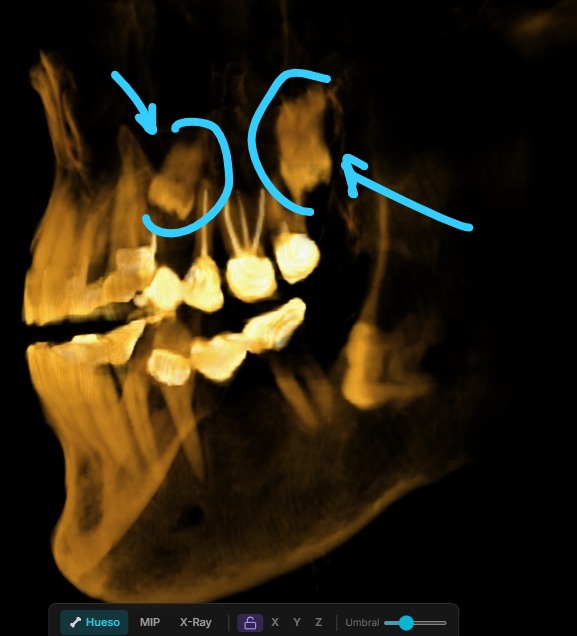 Renderizado 3D volumétrico lateral del maxilar en RADIA con flechas de anotación