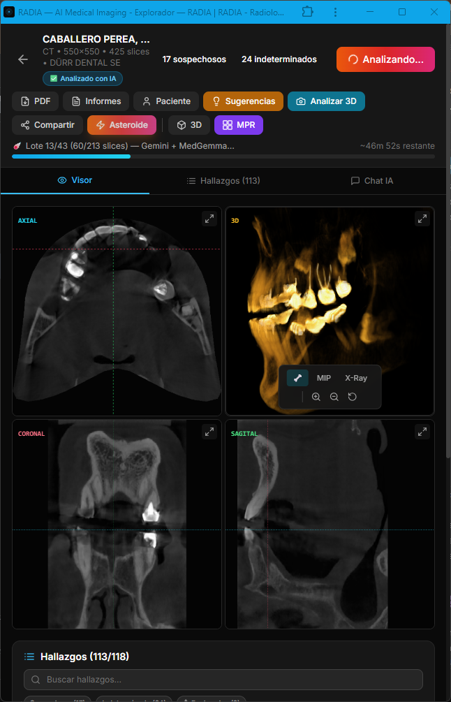 RADIA Modo Asteroide: vista MPR multiplanar completa con cortes axial, 3D volumétrico, coronal y sagital. Lote 13/43, 113 hallazgos, 17 sospechosos, 24 indeterminados. Gemini + MedGemma analizando en paralelo con barra de progreso y ETA