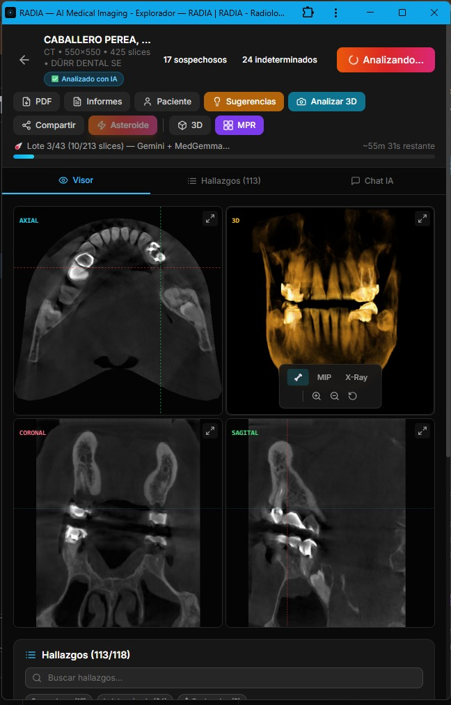 RADIA en Modo Asteroide analizando CT dental CBCT de 425 slices: vista MPR multiplanar con axial, 3D volumétrico, coronal y sagital. Lote 3/43, 113 hallazgos detectados, Gemini + MedGemma en paralelo