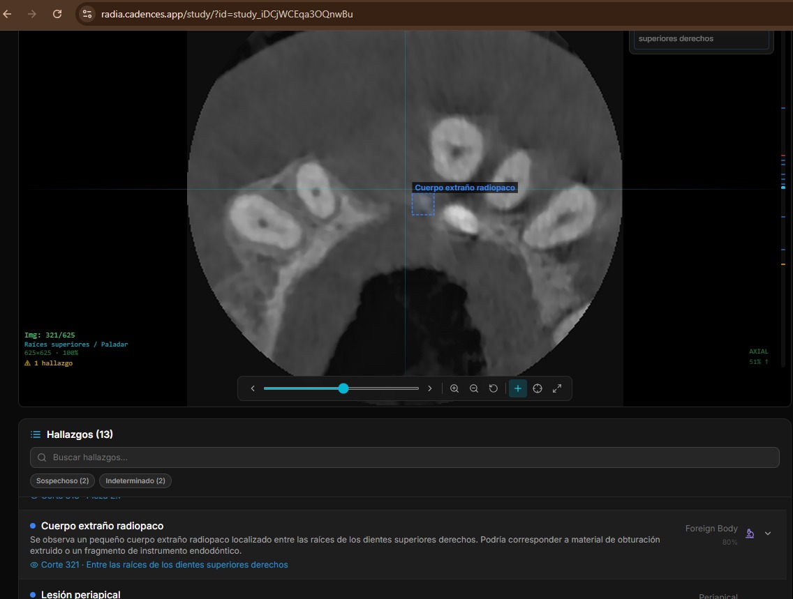 RADIA detectando cuerpo extraño radiopaco entre raíces dentales en CT axial