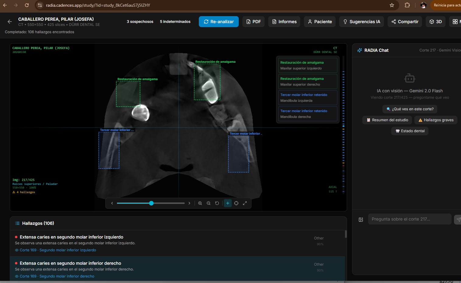 RADIA: Vista completa del visor DICOM con 106 hallazgos detectados por IA, bounding boxes sobre CT axial, panel de Chat IA con Gemini Vision y barra de herramientas