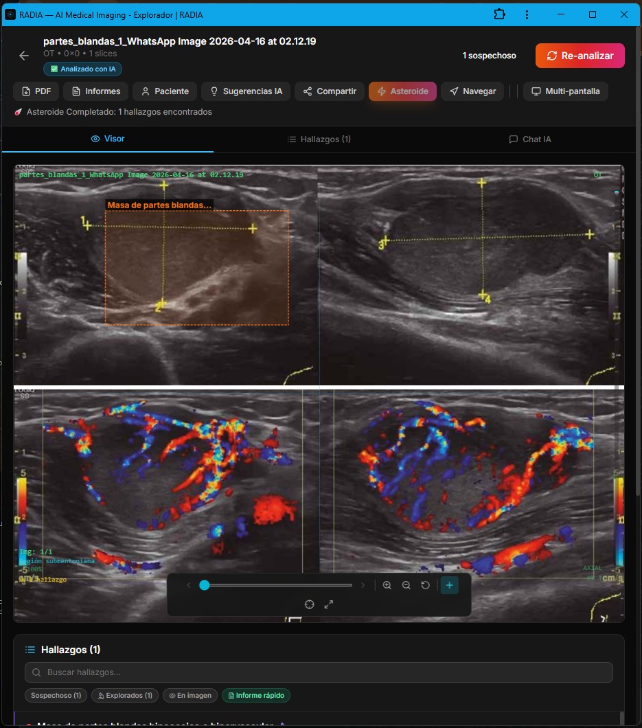 RADIA analizando ecografía de masas de partes blandas: modo B superior mostrando masa hipoecoica con bounding box, Doppler color inferior revelando hipervascularización intensa