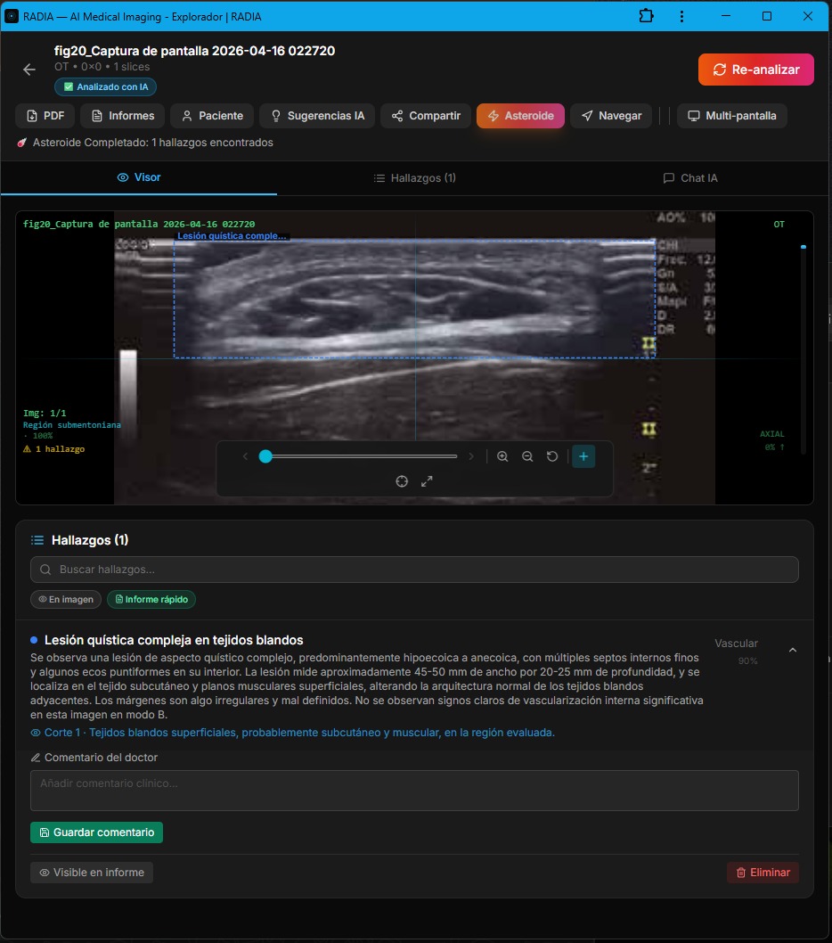 RADIA mostrando lesión quística compleja en ecografía: bounding box cian sobre lesión multiseptada en tejido subcutáneo, hallazgo clasificado como Vascular 90% con campo de comentario del doctor visible