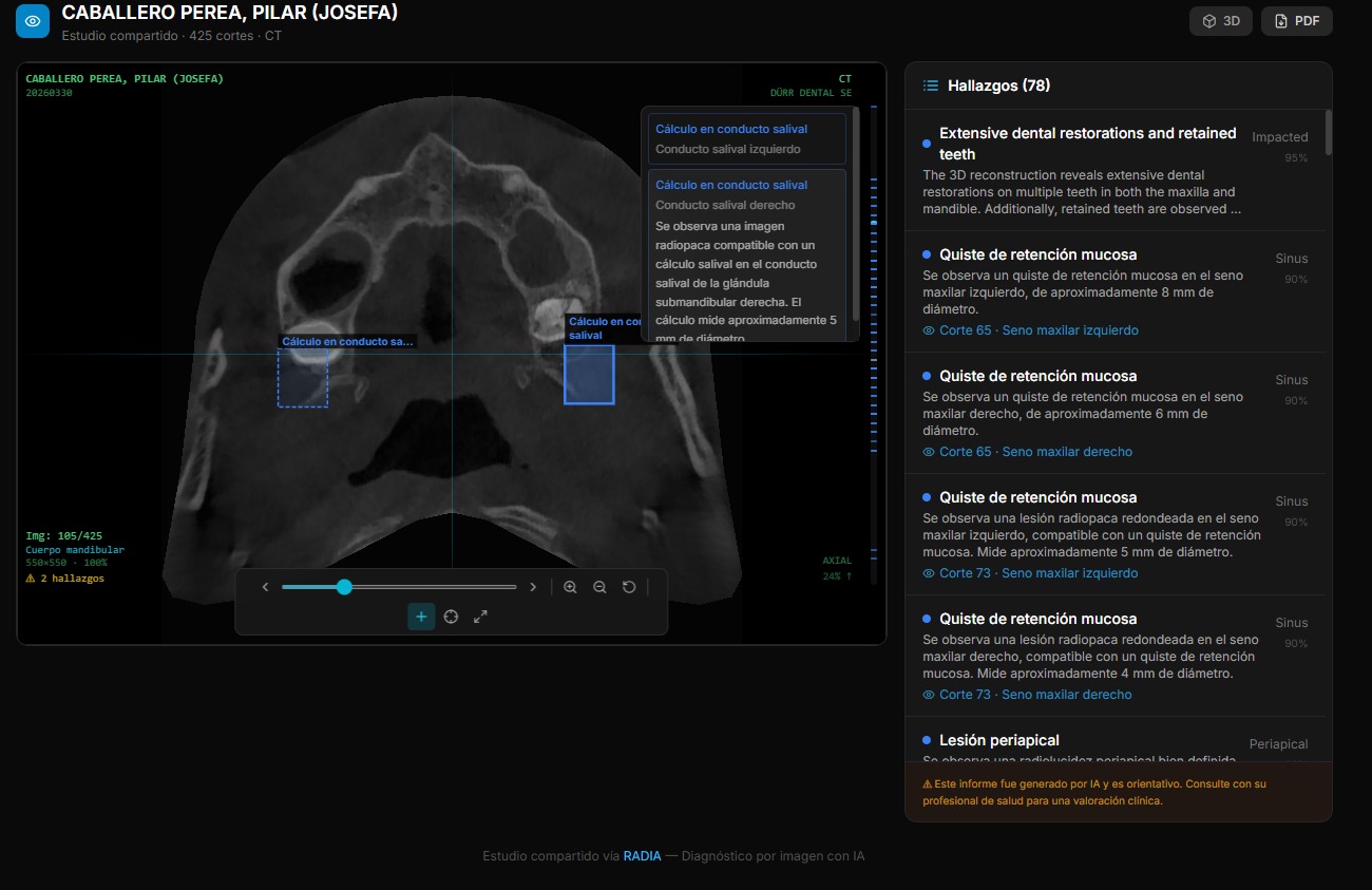 Estudio DICOM compartido en RADIA con panel de 78 hallazgos, bounding boxes sobre CT dental axial mostrando cálculos en conducto salival y quistes de retención mucosa