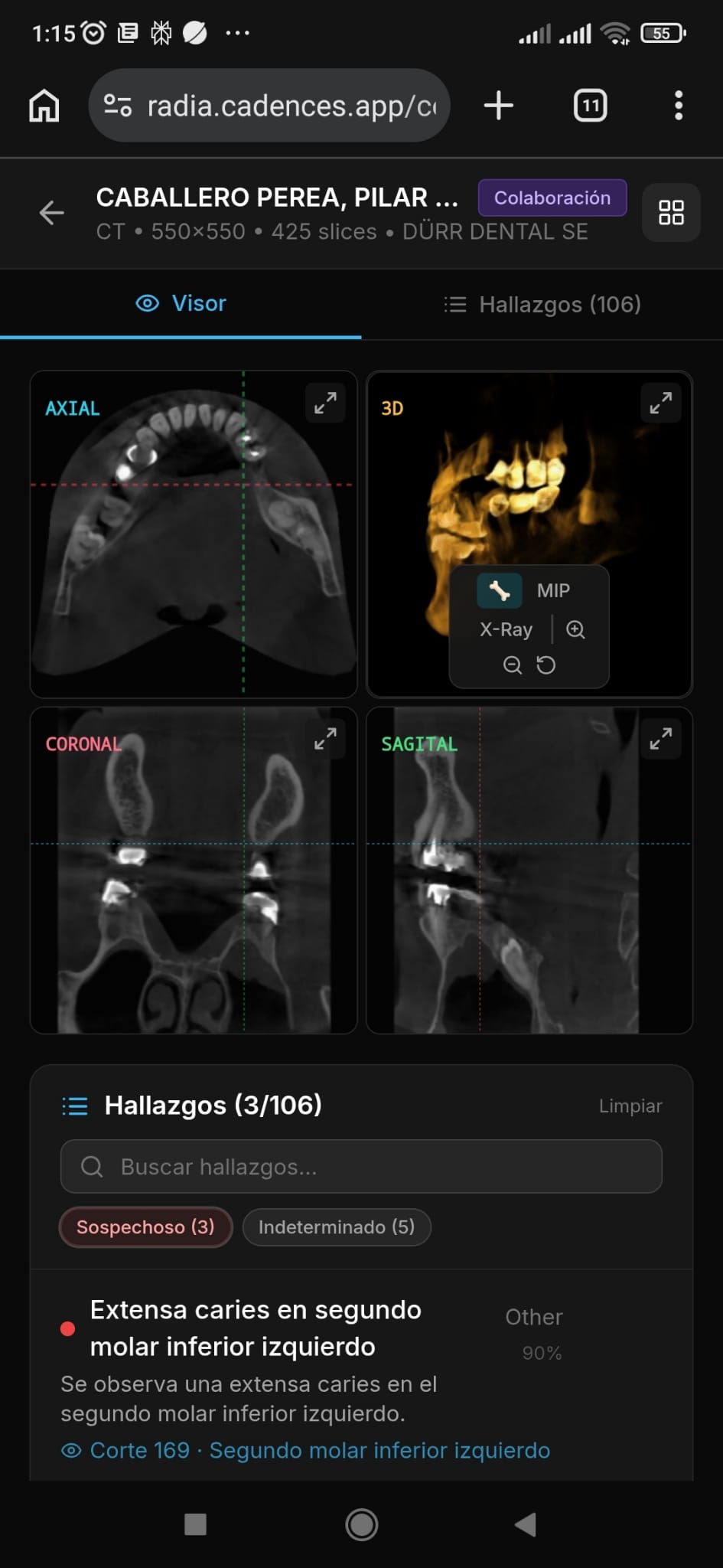 RADIA MPR en móvil: vista multiplanar con paneles axial, coronal, sagital y 3D volumétrico, 106 hallazgos detectados en CT dental CBCT