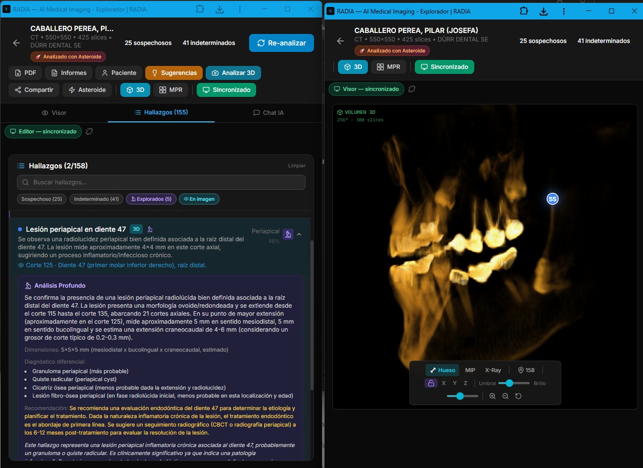 RADIA en configuración multi-monitor: pantalla izquierda con Análisis Profundo de lesión periapical en diente 47 mostrando diferencial clínico, dimensiones 5×5×5mm y recomendación de tratamiento endodóntico. Pantalla derecha con renderizado 3D volumétrico en modo Hueso con marcador de hallazgo y controles debajo del canvas.