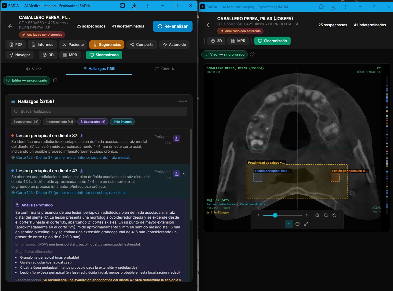 RADIA multi-monitor: editor con análisis profundo de lesión periapical y visor DICOM sincronizado mostrando corte axial 125/425 con bounding boxes sobre hallazgos detectados por IA