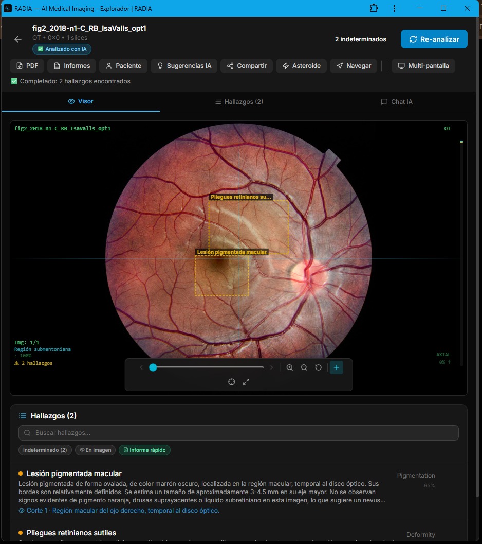 RADIA analizando retinografía con lesión pigmentada macular: bounding box amarillo sobre lesión ovalada marrón oscuro en la mácula, clasificada como Pigmentation 95%
