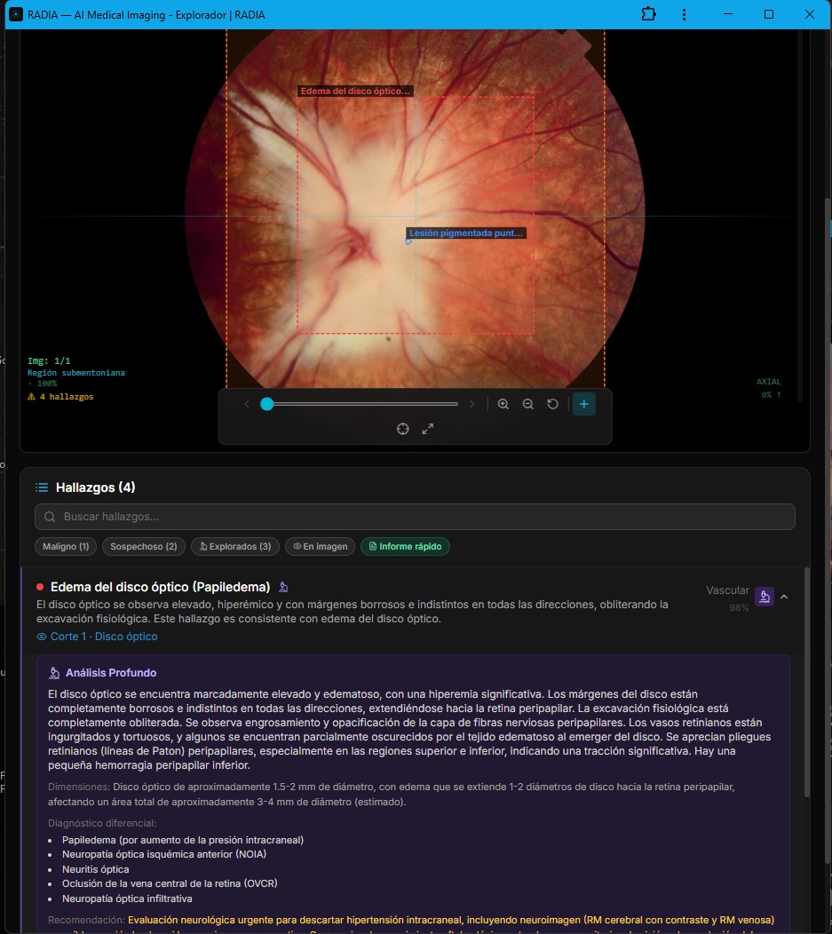 Análisis Profundo de papiledema en RADIA: descripción detallada con dimensiones, diferencial clínico (papiledema, NOIA, neuritis óptica, OVCR) y recomendación urgente de neuroimagen