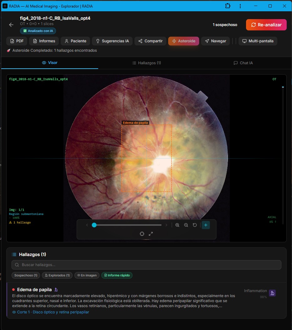 RADIA detectando papiledema en retinografía: disco óptico marcadamente elevado con márgenes borrosos, bounding box con etiqueta Edema de papila - Inflammation 98%