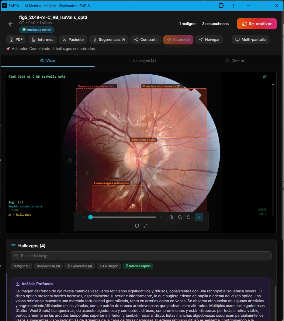 RADIA analizando retinopatía isquémica severa: 4 hallazgos detectados - cambios vasculares retinianos, manchas algodonosas, edema de papila y hemorragias con bounding boxes y análisis profundo visible